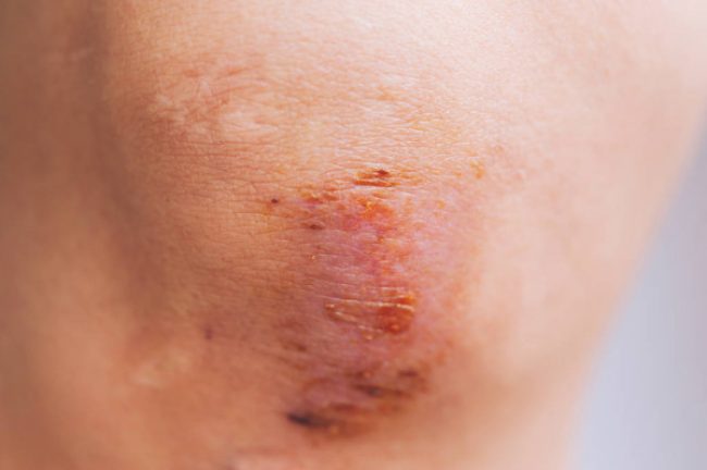 depositphotos_274944922-stock-photo-scar-and-scab-eschar-on